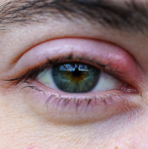 Jęczmień oka – przyczyny, objawy i leczenie