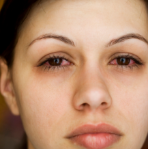 Zapalenie błony naczyniowej oka – jak się objawia?