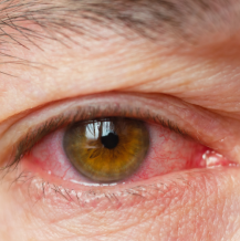 7 sposobów na czerwone oczy