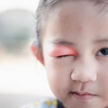 Ropiejące oczy u dziecka – jak temu zaradzić?