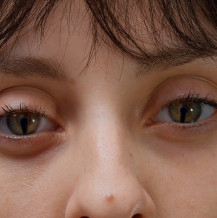 Zespół kociego oka – na czym polega?