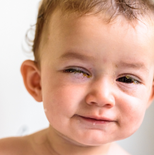 Co na ropiejące oko u dziecka?