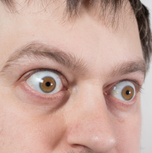 Wytrzeszcz oczu – przyczyny, objawy i leczenie