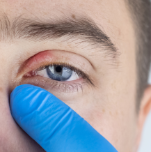 5 najczęstszych infekcji oczu