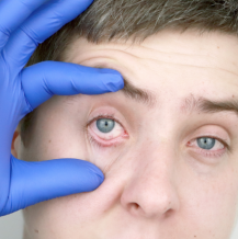 Jakie są choroby widoczne w oczach?